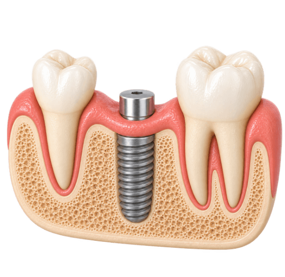 3D cutaway model of a healing dental implant with its healing abutment above the gumline
