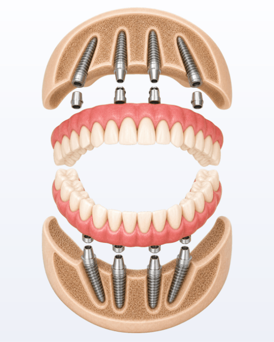 Clinical 3D illustration of upper and lower All-on-X full-arch restorations supported by dental implants