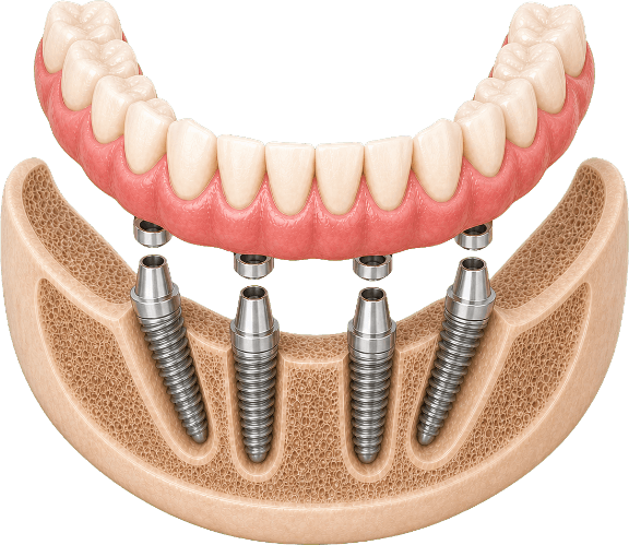 Clinical 3D model of a curved 12-tooth lower full-arch prosthesis supported by four dental implants