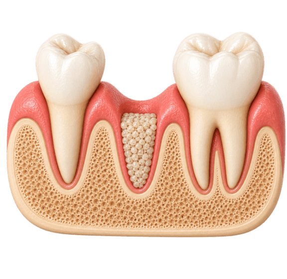 3D cutaway model of a grafted tooth socket between two molars