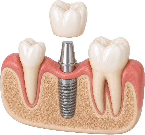 Clinical 3D model of a single dental implant with crown, abutment, and threaded titanium post