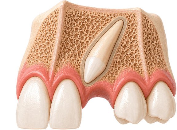 3D cutaway of an unerupted upper canine angled within the jawbone above its missing space