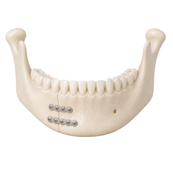 An anatomical model of a repaired lower jaw fracture with fixation plates