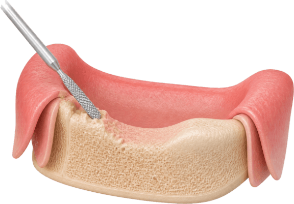 3D render of an edentulous jaw ridge being smoothed and contoured with a surgical instrument