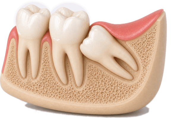 3D cutaway model of an angled wisdom tooth impacted against the neighboring molar