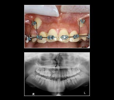 Illustration of an impacted canine tooth beneath the gumline