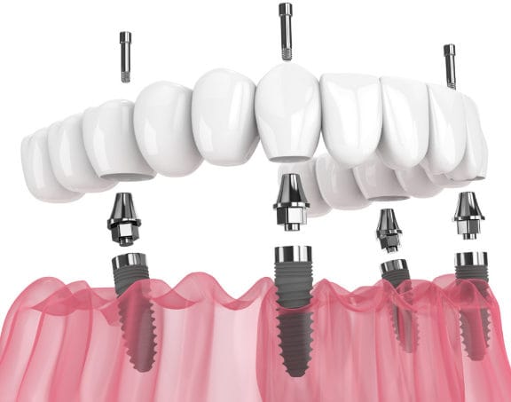 Fixed full-arch prosthesis supported by four implants