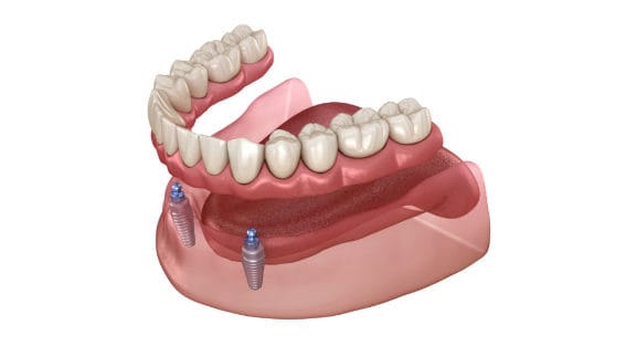Overdenture to be seated on two implants with ball attachments