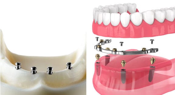 Ball attachments on the left and a bar attachment on the right