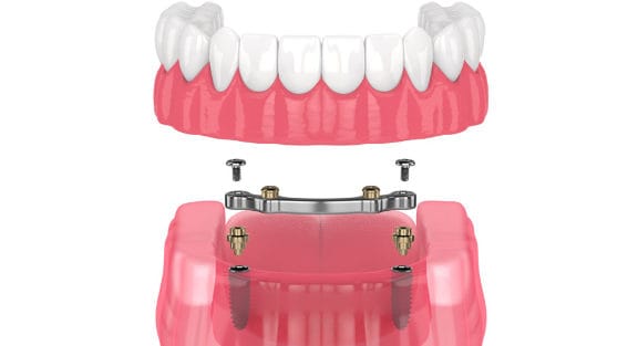 Bar retained removable overdenture on four implants